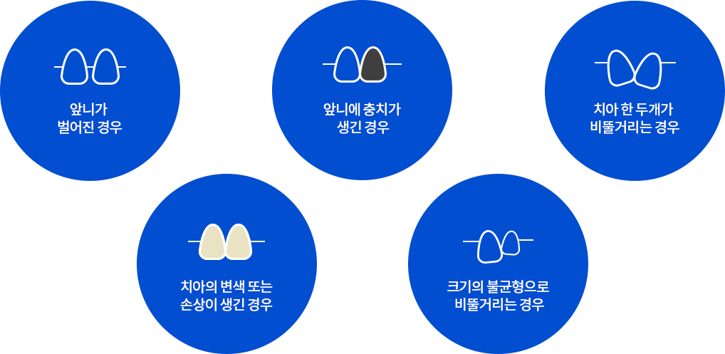 앞니가 벌어진 경우, 앞니에 충치가 생긴 경우, 치아 한 두개가 비뚤거리는 경우, 치아의 변색 또는 손상이 생긴 경우, 아 크기의 불균형으로 비뚤거리는 경우
